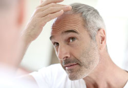 Пересадка волос – процедура против облысения