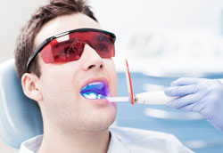 В чём преимущества лазерного отбеливания зубов?